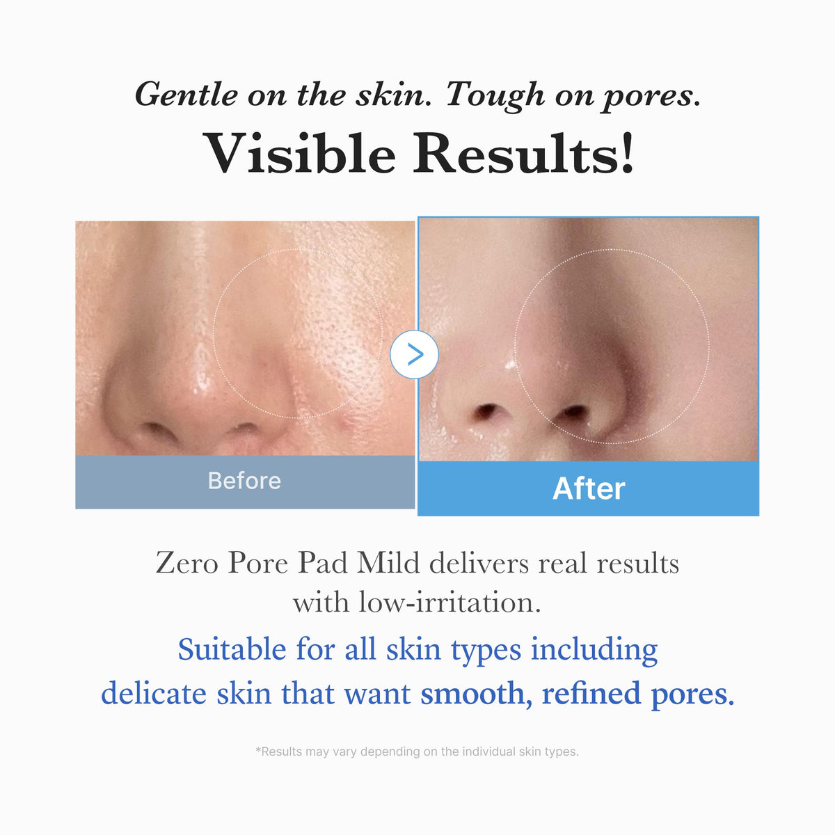 Zero Pore Madecassoside Pads (Mild) B1